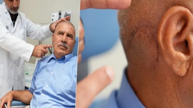 Yüz Felci Korkusu Yüzünden Yıllarca Ertelenen Tümör, Konuşma Yetisini Kaybettirdi